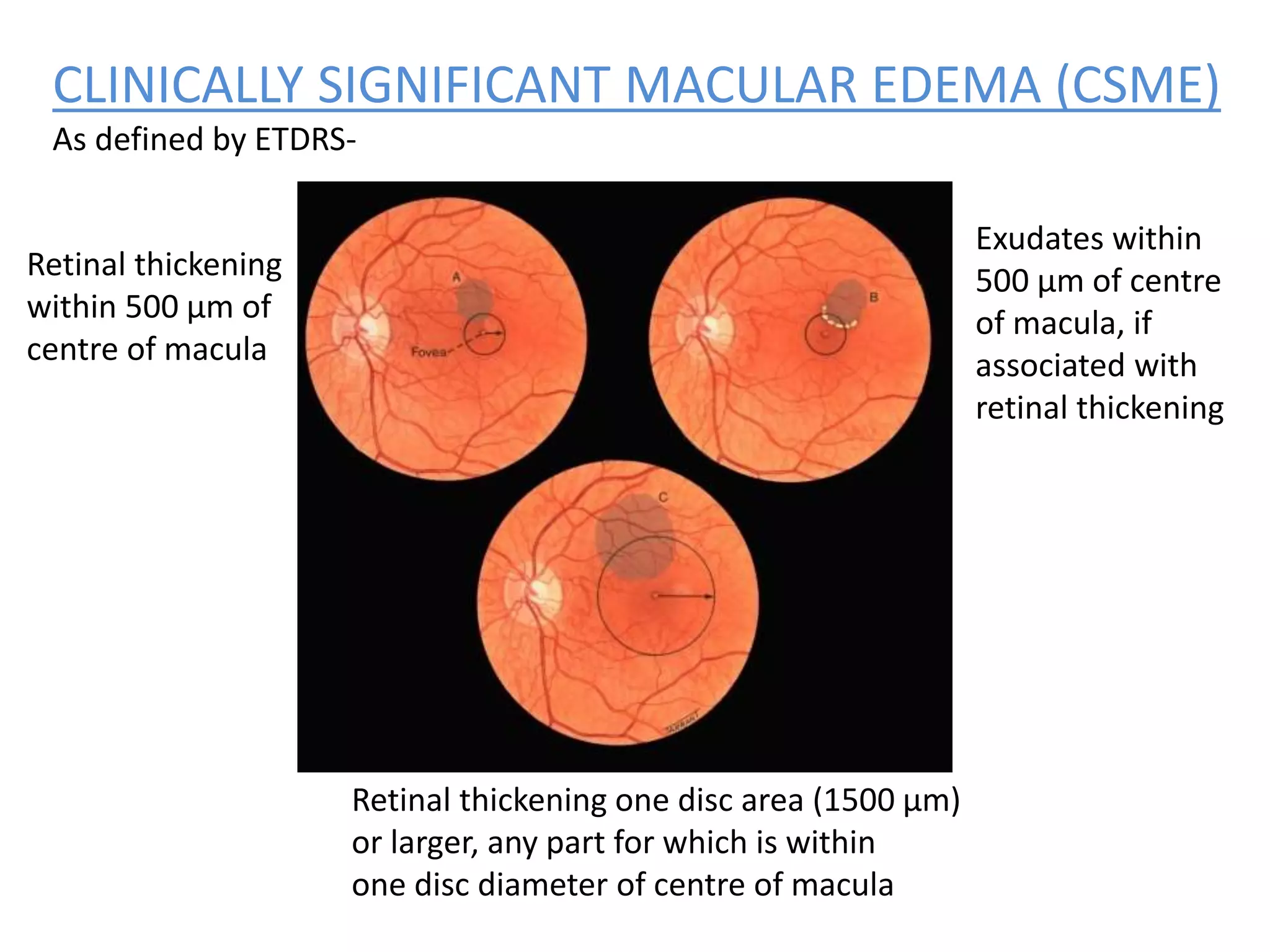 Diabetic retinopathy | PPTX