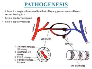 It is a microangiopathy caused by effect of hyperglycemia on small blood
vessels leading to -
• Retinal capillary occlusion
• Retinal capillary leakage
PATHOGENESIS
 
