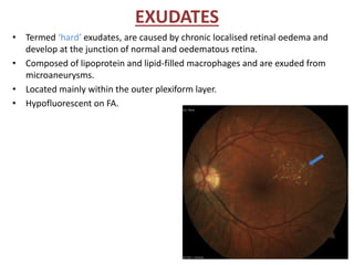 EXUDATES
• Termed ‘hard’ exudates, are caused by chronic localised retinal oedema and
develop at the junction of normal and oedematous retina.
• Composed of lipoprotein and lipid-filled macrophages and are exuded from
microaneurysms.
• Located mainly within the outer plexiform layer.
• Hypofluorescent on FA.
 