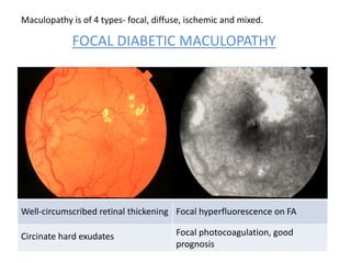 Well-circumscribed retinal thickening Focal hyperfluorescence on FA
Circinate hard exudates Focal photocoagulation, good
prognosis
FOCAL DIABETIC MACULOPATHY
Maculopathy is of 4 types- focal, diffuse, ischemic and mixed.
 