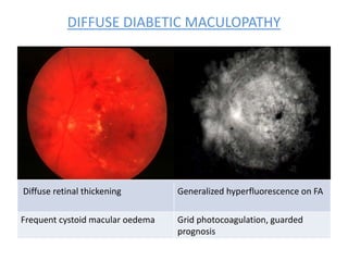 DIFFUSE DIABETIC MACULOPATHY
Diffuse retinal thickening Generalized hyperfluorescence on FA
Frequent cystoid macular oedema Grid photocoagulation, guarded
prognosis
 