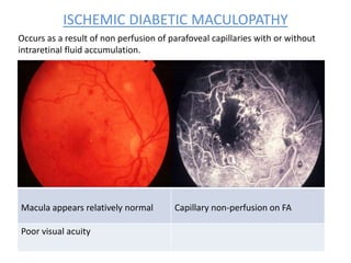 ISCHEMIC DIABETIC MACULOPATHY
Macula appears relatively normal Capillary non-perfusion on FA
Poor visual acuity
Occurs as a result of non perfusion of parafoveal capillaries with or without
intraretinal fluid accumulation.
 