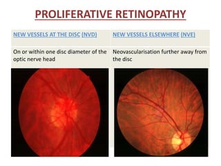 NEW VESSELS AT THE DISC (NVD) NEW VESSELS ELSEWHERE (NVE)
On or within one disc diameter of the
optic nerve head
Neovascularisation further away from
the disc
PROLIFERATIVE RETINOPATHY
 