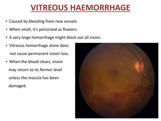 VITREOUS HAEMORRHAGE
• Caused by bleeding from new vessels.
• When small, it’s perceived as floaters.
• A very large hemorrhage might block out all vision.
• Vitreous hemorrhage alone does
not cause permanent vision loss.
• When the blood clears, vision
may return to its former level
unless the macula has been
damaged.
 