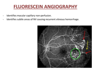 FLUORESCEIN ANGIOGRAPHY
- Identifies macular capillary non-perfusion.
- Identifies subtle areas of NV causing recurrent vitreous hemorrhage.
 