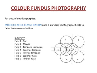 COLOUR FUNDUS PHOTOGRAPHY
For documentation purpose.
MODIFIED AIRLIE CLASSIFICATION uses 7 standard photographic fields to
detect neovascularisation.
RIGHT EYE
Field 1 - Disc
Field 2 - Macula
Field 3 - Temporal to macula
Field 4 - Superior-temporal
Field 5 - Inferior-temporal
Field 6 - Superior-nasal
Field 7 - Inferior-nasal
 