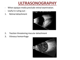 ULTRASONOGRAPHY
- When opaque media preclude retinal examination.
- Useful in ruling out :
1. Retinal detachment
2. Traction threatening macular detachment
3. Vitreous hemorrhage
 