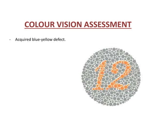 COLOUR VISION ASSESSMENT
- Acquired blue-yellow defect.
 