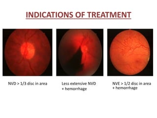 INDICATIONS OF TREATMENT
NVD > 1/3 disc in area Less extensive NVD
+ hemorrhage
NVE > 1/2 disc in area
+ hemorrhage
 