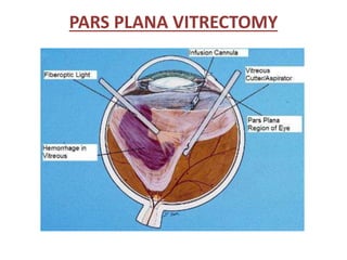 PARS PLANA VITRECTOMY
 