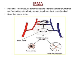 EPIRETINAL MEMBRANE
• Also known as macular pucker, pre-macular fibrosis, surface wrinkling retinopathy
or cellophane macu...