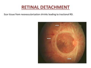 RETINAL DETACHMENT
Scar tissue from neovascularization shrinks leading to tractional RD.
 