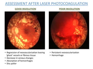 ASSESSMENT AFTER LASER PHOTOCOAGULATION
GOOD INVOLUTION POOR INVOLUTION
• Regression of neovascularization leaving
‘ghost’ vessels or fibrous tissue
• Decrease in venous changes
• Absorption of hemorrhages
• Disc pallor
• Persistent neovascularization
• Hemorrhage
 