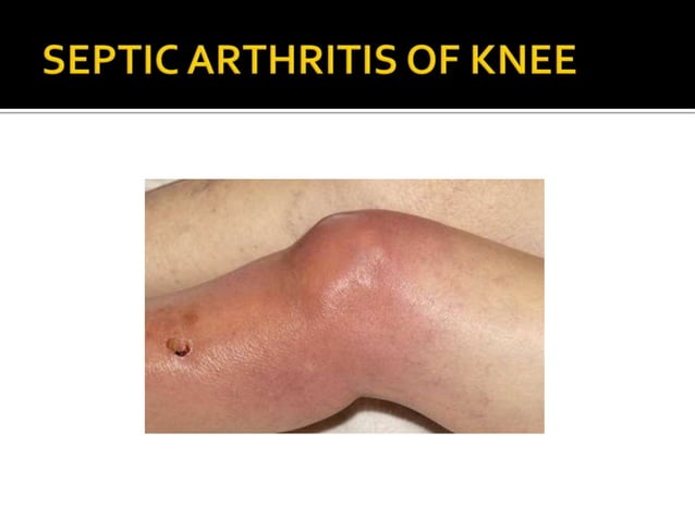 Bone Infections | PPT