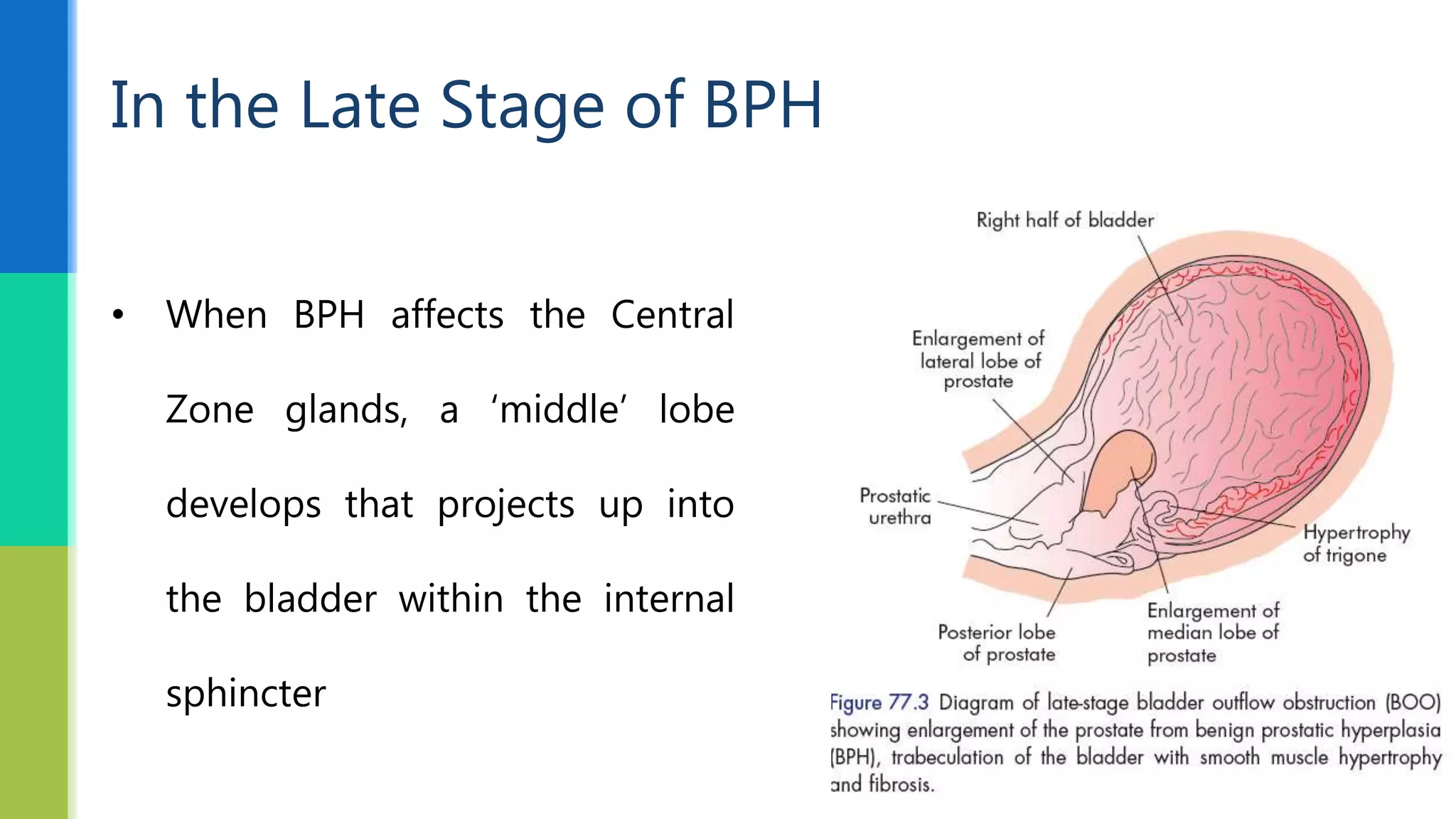 BPH- Pathology & Investigations | PPTX