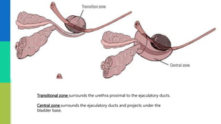 Transitional zone surrounds the urethra proximal to the ejaculatory ducts.
Central zone surrounds the ejaculatory ducts and projects under the
bladder base.
 