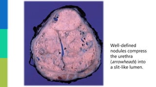 Well-defined
nodules compress
the urethra
(arrowheads) into
a slit-like lumen.
 