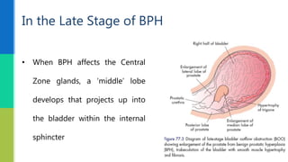 In the Late Stage of BPH
• When BPH affects the Central
Zone glands, a ‘middle’ lobe
develops that projects up into
the bladder within the internal
sphincter
 