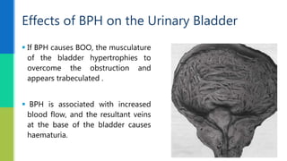  If BPH causes BOO, the musculature
of the bladder hypertrophies to
overcome the obstruction and
appears trabeculated .
 BPH is associated with increased
blood flow, and the resultant veins
at the base of the bladder causes
haematuria.
Effects of BPH on the Urinary Bladder
 