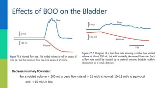 Effects of BOO on the Bladder
Decrease in urinary flow rates :
For a voided volume > 200 ml, a peak flow rate of > 15 ml/s is normal, 10–15 ml/s is equivocal
and < 10 ml/s is low.
 