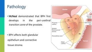  McNeal demonstrated that BPH first
develops in the peri-urethral
transition zone of the prostate.
 BPH affects both glandular
epithelium and connective
tissue stroma.
Pathology
 