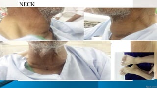  FACE: No signs of puffiness, proptosis, xanthelasma
 TOUNGUE:dryness present ,size of toungue
normal.no sign of jaundice or cynosis.
 Colour of conjuntiva:its dirty and hazy. Rt eye has
cornea is not visible with blind eye .no sign of jaundice or
pallor
NECK
Thyroid:Inspection:enlarged swelling moving up with
deglutition and bosselated
palpation:diffuse enlarge pin size multiple nodules
consistency is firm no tenderness and no pressure effect
No sign of thyrotoxicosis berry sign –ve and pamberton sign –ve
percussion:no extension to retersternal goiter
Auscultation:No bruit
LYMPH NODE:NOT PALPABLE
FEET: NO DEFORMITY OR EDEMA
 