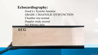 Echocardiography:
Good Lv Systolic function
GRADE 1 DIASTOLIC DYSFUNCTION
Chamber size normal
Doppler study normal
NO RWMA SSN
ECG
 
