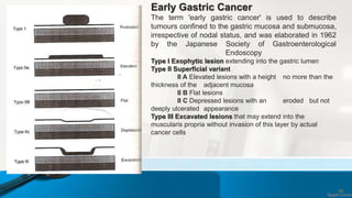 Early Gastric Cancer
The term 'early gastric cancer' is used to describe
tumours confined to the gastric mucosa and submucosa,
irrespective of nodal status, and was elaborated in 1962
by the Japanese Society of Gastroenterological
Endoscopy
Type I Exophytic lesion extending into the gastric lumen
Type II Superficial variant
II A Elevated lesions with a height no more than the
thickness of the adjacent mucosa
II B Flat lesions
II C Depressed lesions with an eroded but not
deeply ulcerated appearance
Type III Excavated lesions that may extend into the
muscularis propria without invasion of this layer by actual
cancer cells
52
 