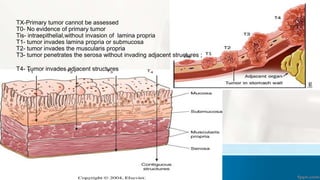 TX-Primary tumor cannot be assessed
T0- No evidence of primary tumor
Tis- intraepithelial,without invasion of lamina propria
T1- tumor invades lamina propria or submucosa
T2- tumor invades the muscularis propria
T3- tumor penetrates the serosa without invading adjacent structures ;
T4- Tumor invades adjacent structures
 