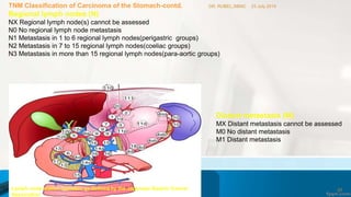 TNM Classification of Carcinoma of the Stomach-contd.
Regional lymph nodes (N)
NX Regional lymph node(s) cannot be assessed
N0 No regional lymph node metastasis
N1 Metastasis in 1 to 6 regional lymph nodes(perigastric groups)
N2 Metastasis in 7 to 15 regional lymph nodes(coeliac groups)
N3 Metastasis in more than 15 regional lymph nodes(para-aortic groups)
Distant metastasis (M)
MX Distant metastasis cannot be assessed
M0 No distant metastasis
M1 Distant metastasis
Lymph node station numbers as defined by the Japanese Gastric Cancer
Association
23 July 2016DR. RUBEL,SBMC
57
 