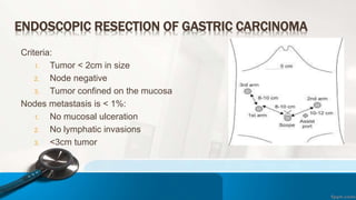 ENDOSCOPIC RESECTION OF GASTRIC CARCINOMA
Criteria:
1. Tumor < 2cm in size
2. Node negative
3. Tumor confined on the mucosa
Nodes metastasis is < 1%:
1. No mucosal ulceration
2. No lymphatic invasions
3. <3cm tumor
 