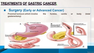 TREATMENTS OF GASTRIC CANCER:
 Surgery (Early or Advanced Cancer)
 Proximal tumours which involve the fundus, cardia or body (total
gasterectomy)
 