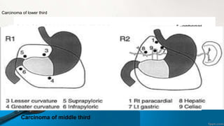 CARCINOMA UPPER THIRD
Carcinoma of middle third
Carcinoma of lower third
 