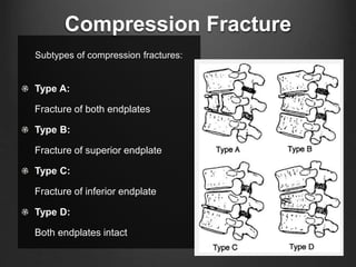 Compression Fracture
Subtypes of compression fractures:
Type A:
Fracture of both endplates
Type B:
Fracture of superior endplate
Type C:
Fracture of inferior endplate
Type D:
Both endplates intact
 