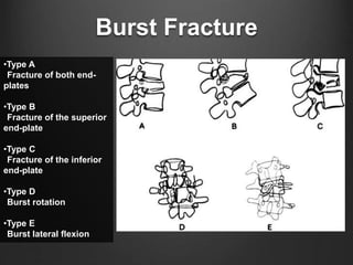 Burst Fracture
•Type A
Fracture of both end-
plates
•Type B
Fracture of the superior
end-plate
•Type C
Fracture of the inferior
end-plate
•Type D
Burst rotation
•Type E
Burst lateral flexion
 