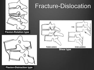 Fracture-Dislocation
Shear type
Flexion-Rotation type
Flexion-Distraction type
 