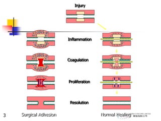Injury
Inflammation
Coagulation
Resolution
Proliferation
Surgical Adhesion Normal Healing3
 