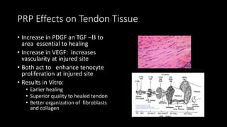 PRP Effects on Tendon Tissue
• Increase in PDGF an TGF –B to
area essential to healing
• Increase in VEGF: increases
vascularity at injured site
• Both act to enhance tenocyte
proliferation at injured site
• Results in Vitro:
• Earlier healing
• Superior quality to healed tendon
• Better organization of fibroblasts
and collagen
 