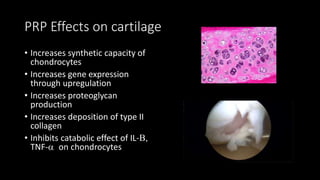 PRP Effects on cartilage
• Increases synthetic capacity of
chondrocytes
• Increases gene expression
through upregulation
• Increases proteoglycan
production
• Increases deposition of type II
collagen
• Inhibits catabolic effect of IL-B,
TNF-a on chondrocytes
 