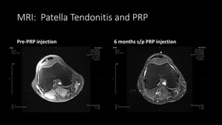 MRI: Patella Tendonitis and PRP
Pre-PRP injection 6 months s/p PRP injection
 