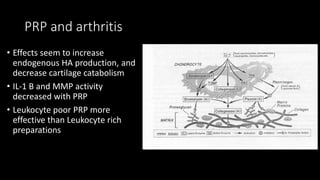PRP and arthritis
• Effects seem to increase
endogenous HA production, and
decrease cartilage catabolism
• IL-1 B and MMP activity
decreased with PRP
• Leukocyte poor PRP more
effective than Leukocyte rich
preparations
 
