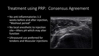 Treatment using PRP: Consensus Agreement
• No anti-inflammatories 1-2
weeks before and after injection,
“Washout period”
• No local anesthetic to injection
site—Alters pH which may alter
function
• Ultrasound use preferred for
tendons and Muscular injections
 
