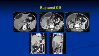 Ruptured GB
 