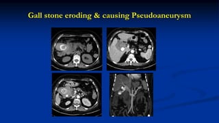 Gall stone eroding & causing Pseudoaneurysm
 