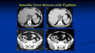Amoebic Liver Abscess with Typhlitis
 
