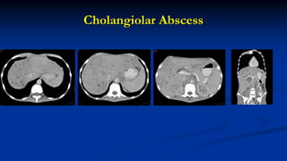 Cholangiolar Abscess
 
