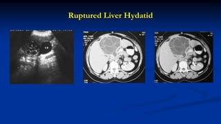 Ruptured Liver Hydatid
 