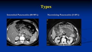 Types
Interstitial Pancreatitis (80-90%) Necrotizing Pancreatitis (5-10%)
 