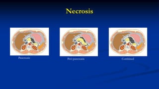 Necrosis
Pancreatic Peri-pancreatic Combined
 