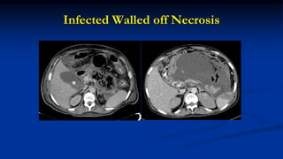 Infected Walled off Necrosis
 